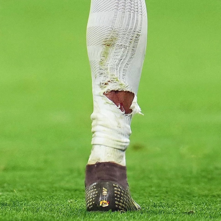 真人百家乐游戏官网-有点狠！塔蹬踏姆巴佩小腿染黄，姆巴佩小腿袜被踩破露出血痕